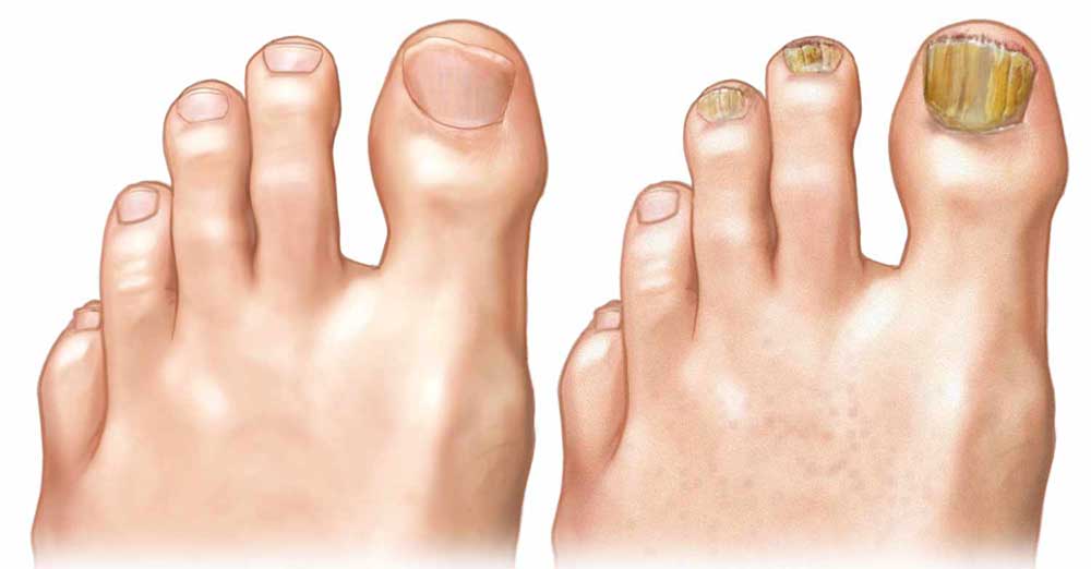 izgled_nohta_glivice